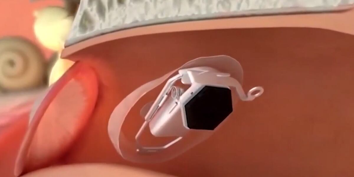 Red Earlens Can you hear me now? Earlens for your hearing