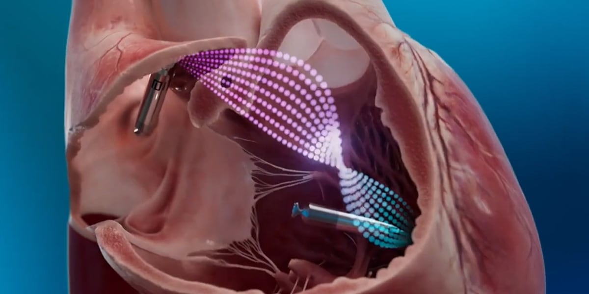 Unshielded Pacemaker The new “no surgery, no wires” pacemaker