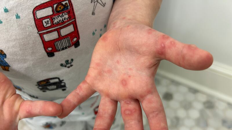 FILE -- The state's health department says there is a sharp uptick in the disease, with it...